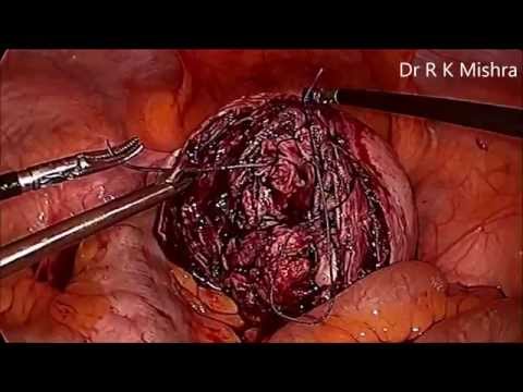 Laparoscopic Myomectomy For Intramural Big Fibroid Uterus