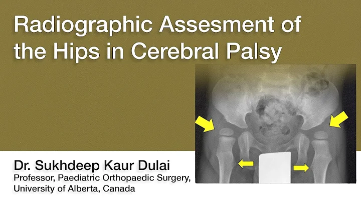 Radiographic Assessment of the Hips in Cerebral Palsy | Dr. Sukhdeep Kaur Dulai
