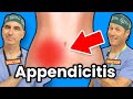 Appendicitis - How Do I Know If I Have Appendicitis?