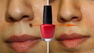 Nail Paint से तिल - मस्से और दाग ऐसे गायब होंगे जैसे कभी थे ही नहीं -100% Working | Remove Moles