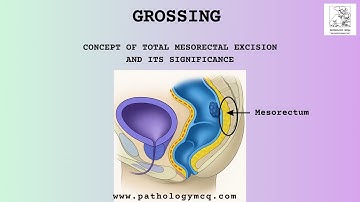 Total Mesorectal Excision (TME) – Concept Overview- TME Concept
