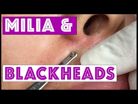 Blackheads & Milia Extractions In A Young Woman