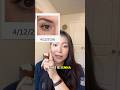 Dark circles before & after