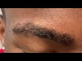 Dallas 5 Month Early African American Male Eyebrow Transplant Close-Up Result