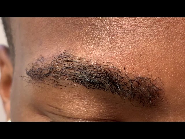 Dallas 5 Month Early African American Male Eyebrow Transplant Close-Up Result