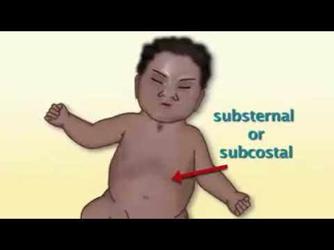 Video: Apakah retraksi subkostal normal pada bayi baru lahir?