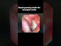 Beard growing inside the laryngeal cavity
