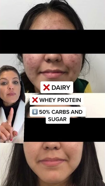 does-diet-affect-acne-a-dermatologist-answers-shorts-youtube