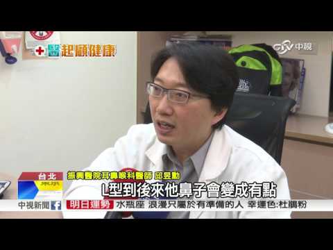 隆鼻後鼻子破洞? 隆鼻材料怎麼挑│中視新聞 20170410