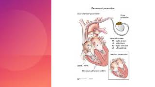 Basic Cardiac Pacing (2/2) Dr Mohamad Maghawry