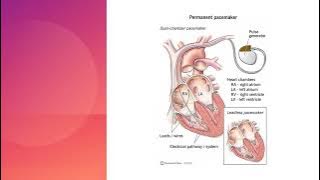 Basic Cardiac Pacing  (2/2) Dr Mohamad Maghawry