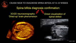 Crash Sign: Diagnosis of Spina Bifida at 11-13 weeks