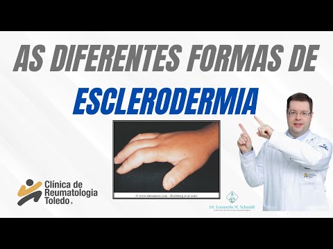 Vídeo: Onde a esclerodermia afeta você?