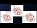 Microsurgical Resection of Large Cervical Spinal Cord Cavernous Malformation