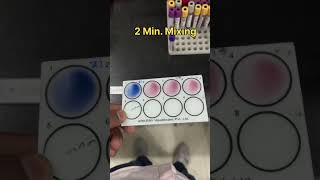 Widal test #typhoid #lab #viralfever #pathologylab #labtechnician #widaltest #science #labtech