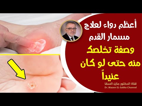 أعظم دواء علاج مسمار القدم الفعال بدون ادوية، ما لا تعرفه عن مسمار القدم أسبابه وعلاجه وطرق الوقاية