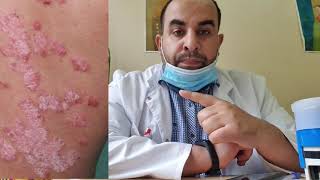 هل مرض الصدفية Psoriasis معدي؟ مزمن؟ الاسباب والعلاج