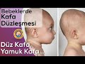 Bebeklerde Kafa Düzleşmesi ve Yamukluk (Plagiosefali)