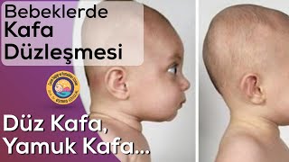 Bebeklerde Kafa Düzleşmesi ve Yamukluk (Plagiosefali) Resimi