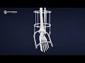 Double medical ilizarov external fixator circular  external fixation surgery techniques animation