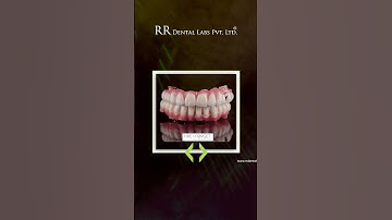 RR Dental Labs  Fire & Forget Implants & I-Dent Aligners  Precision Dental Technology in India