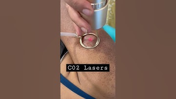 Thumbnail of C02 Lasers | scars correction | keratosis #drmonaswamy #skincare #glowingskin #acnescars