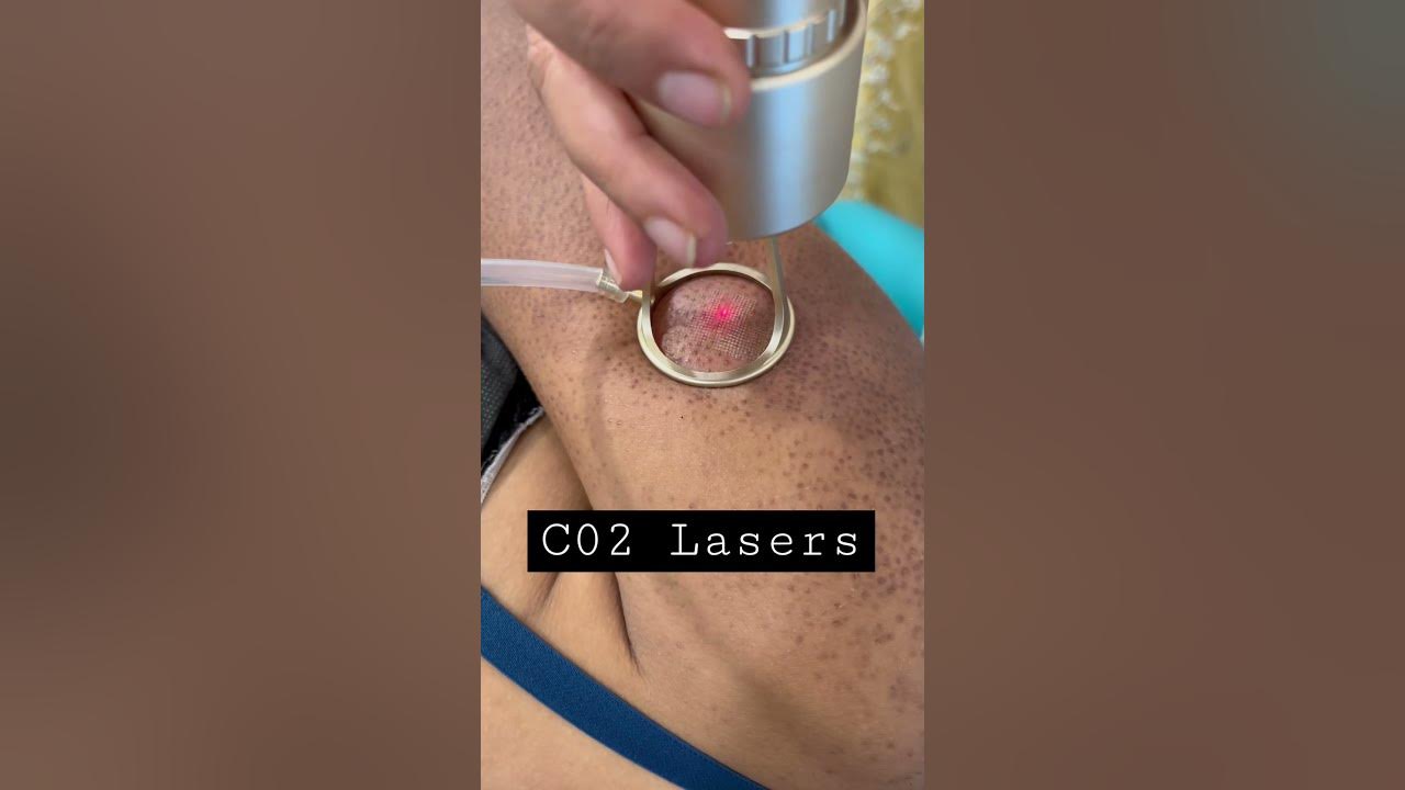 C02 Lasers | scars correction | keratosis #drmonaswamy #skincare #glowingskin #acnescars
