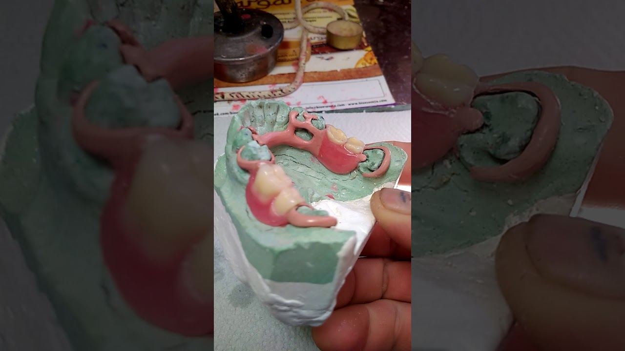 PPR DE BIOSTRONG (PEEK)