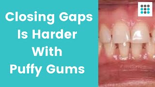 CLOSING GAPS IS HARDER IF YOU HAVE PUFFY GUMS l Dr. Bailey Orthodontist #shorts
