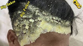 DRY SCALP !! Big Flakes Dandruff Scratching Satisfying Video #1008