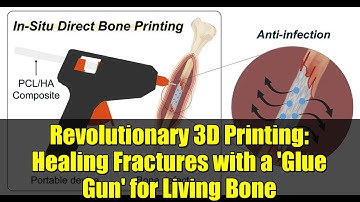 Revolutionary 3D Printing: Healing Fractures with a 