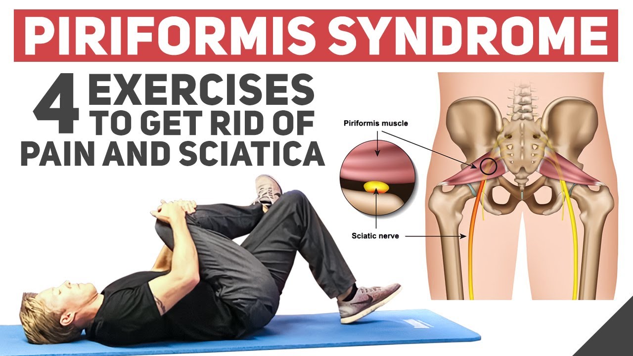 Piriformis Syndrome - Home Stretches & Exercises 