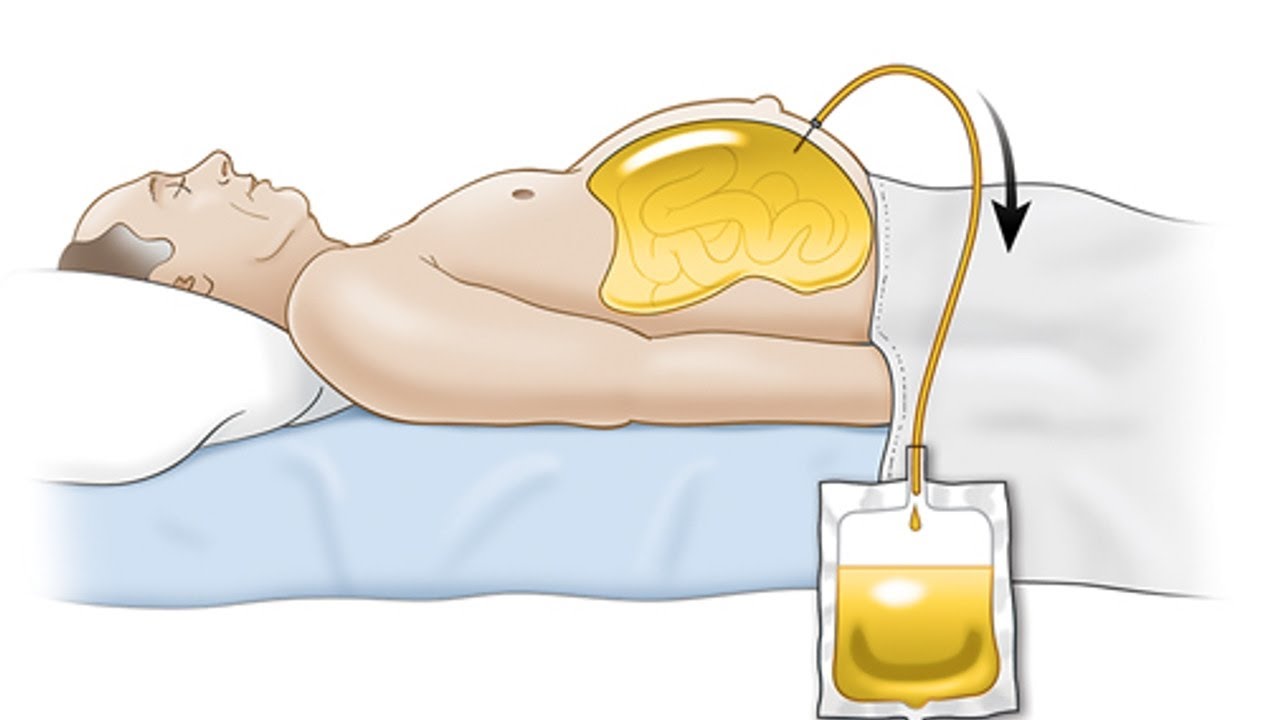 Spontaneous bacterial peritonitis 