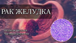 Рак желудка | Частная патология