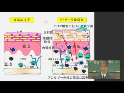 ①アトピー性皮膚炎の原因と悪化因子