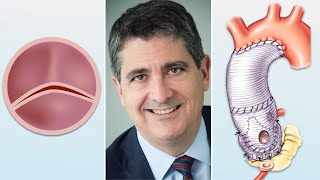 Surgeon Q&A: Bicuspid Aortic Valve & Valve Sparing Root Replacement Advantages with Dr. Eric Roselli