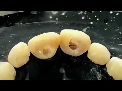 Internal Bleaching