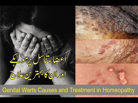 Genital Warts, Anal Warts Completely Removed in Homeopathy hindi/urdu by Dr. safdar Iqbal