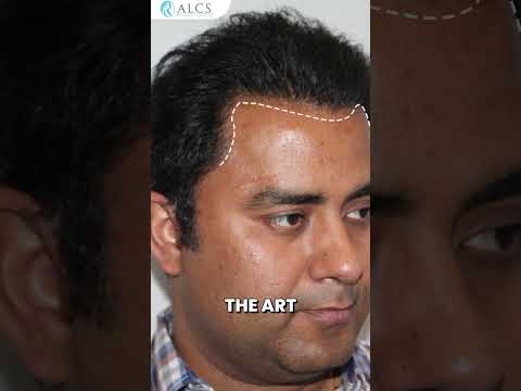 Hair Transplant Is