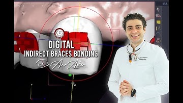 Digital Indirect Braces Bonding By Dr.Amr Asker