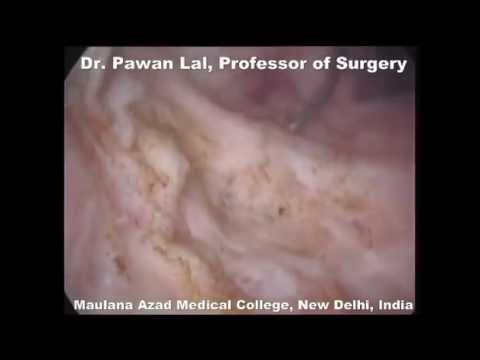 drainage prostate abscess