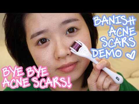 How to Get Rid of Acne Scars! | Banish Acne Scars Demo