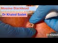 Massive Blackhead Removed. Dr Khaled Sadek. Www.lipomacyst.com