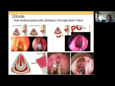 Vidéo: Cancer Du Larynx - Stades, Symptômes, Diagnostic, Traitement, Prévention