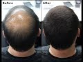 Thick fiber   hair building fibers is a hair loss concealer fiber cover up bald patches
