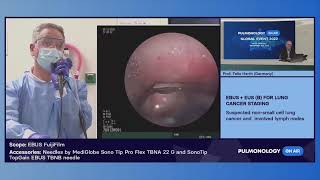 EBUS + EUS (B) for Lung Cancer Staging | Yashoda Hospitals Hyderabad