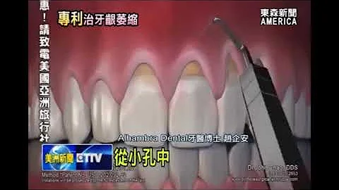 美國名醫「趙企安」|可根治牙齦萎縮 - 天天要聞