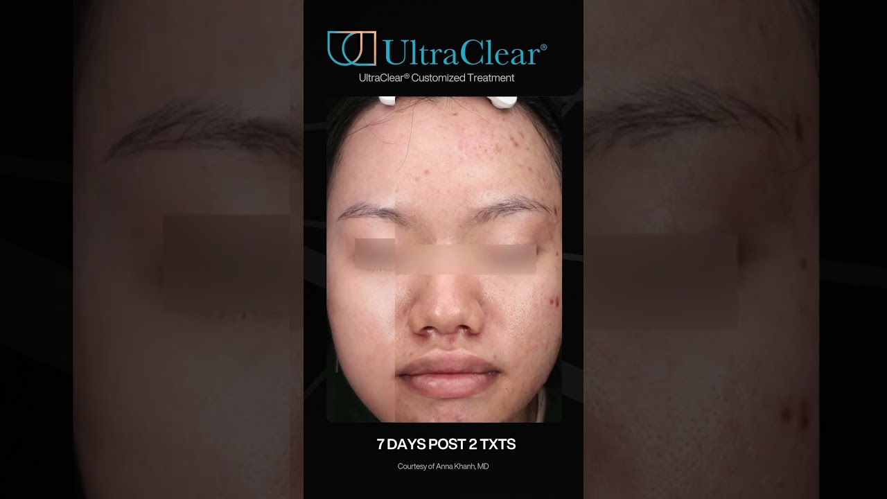 UltraClear Transformation: Acne Scars in Just 2 Treatments ✨ #ultraclear #beforeandafter