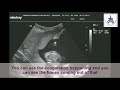 Cord coagulation procedure was done by dr jayesh patel at paaranu ivf surat gujarat india