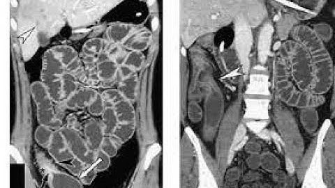 CT Enteroclysis Procedure